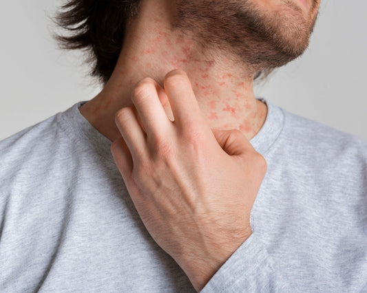 Homme se grattant le cou avec des rougeurs visibles et une irritation cutanée évoquant l’eczéma ou une peau sensible